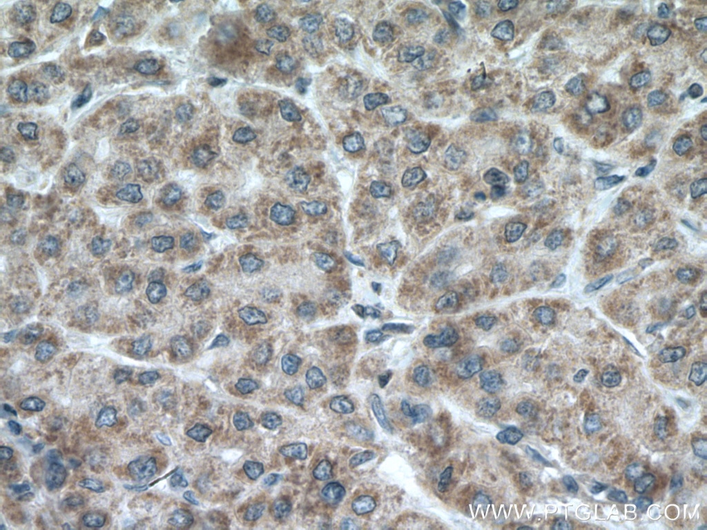 Immunohistochemistry (IHC) staining of human liver cancer tissue using VHL Polyclonal antibody (16538-1-AP)
