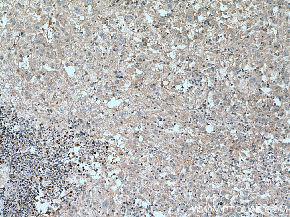 Immunohistochemistry (IHC) staining of human liver cancer tissue using VHL Polyclonal antibody (16538-1-AP)