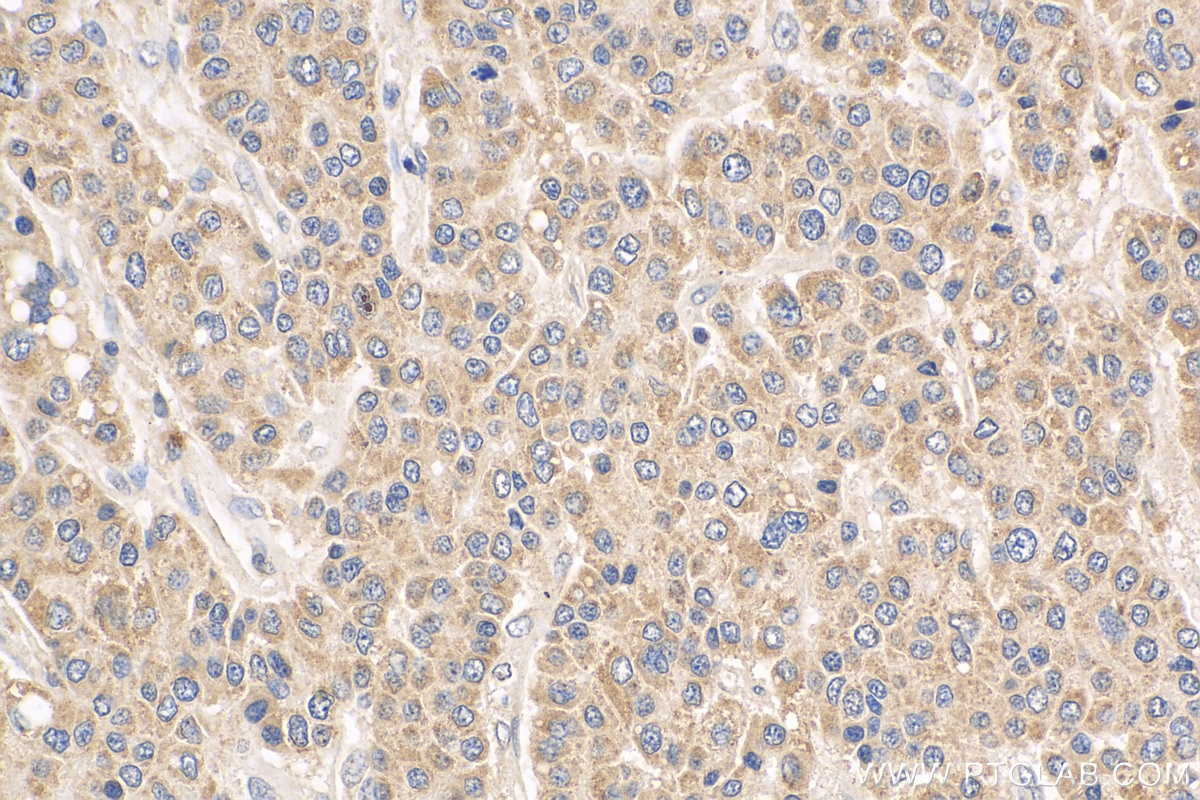 Immunohistochemistry (IHC) staining of human liver cancer tissue using VHL Polyclonal antibody (24756-1-AP)