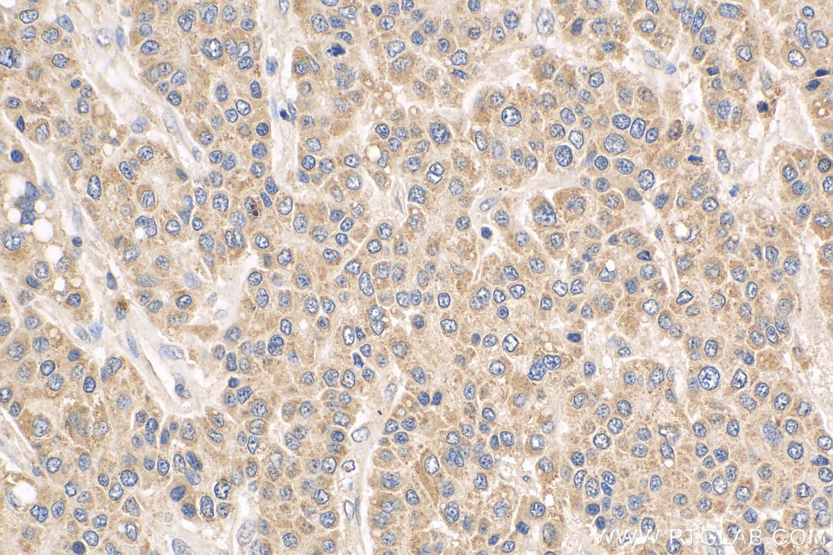 IHC staining of human liver cancer using 24756-1-AP