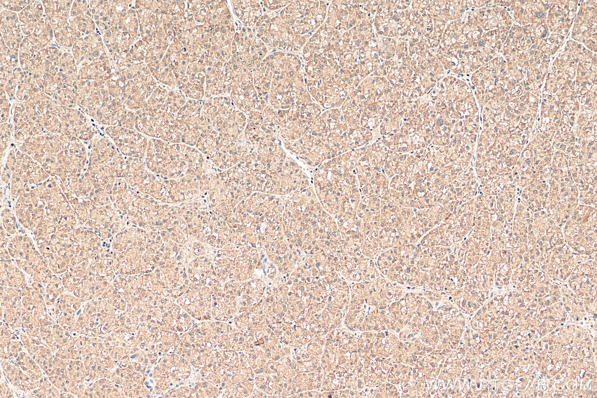 Immunohistochemistry (IHC) staining of human liver cancer tissue using VHL Polyclonal antibody (24756-1-AP)