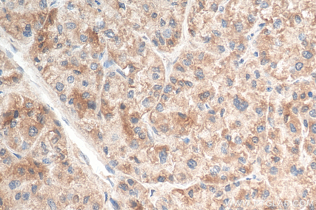 Immunohistochemistry (IHC) staining of human liver cancer tissue using VHL Polyclonal antibody (24756-1-AP)