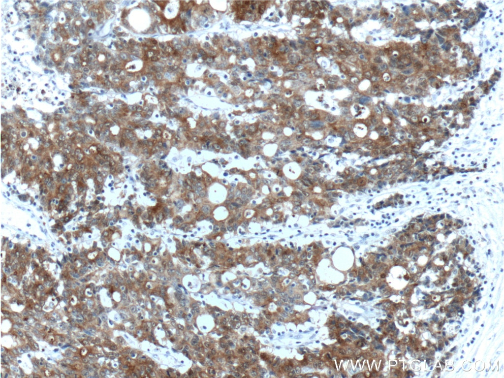 Immunohistochemistry (IHC) staining of human colon cancer tissue using Villin Polyclonal antibody (16488-1-AP)