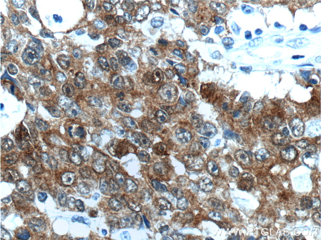 Immunohistochemistry (IHC) staining of human colon cancer tissue using Villin Polyclonal antibody (16488-1-AP)