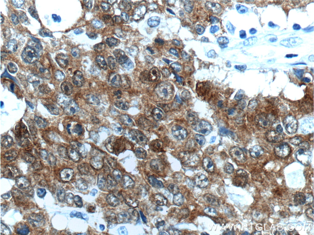 IHC staining of human colon cancer using 16488-1-AP