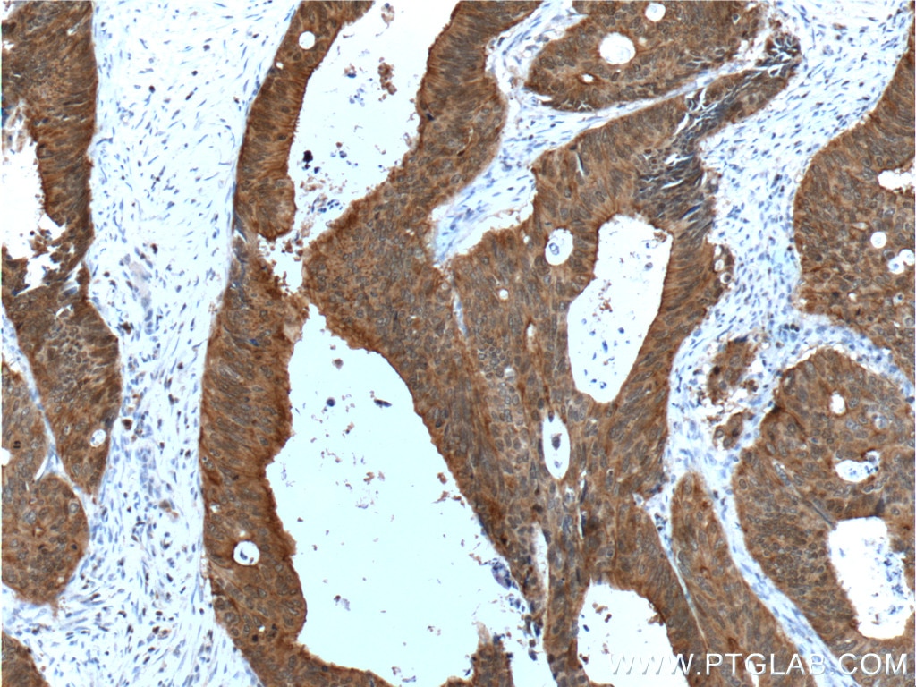 Immunohistochemistry (IHC) staining of human colon cancer tissue using Villin Monoclonal antibody (66096-1-Ig)