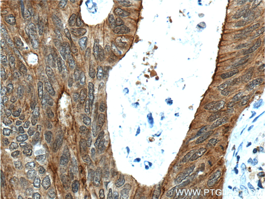 IHC staining of human colon cancer using 66096-1-Ig