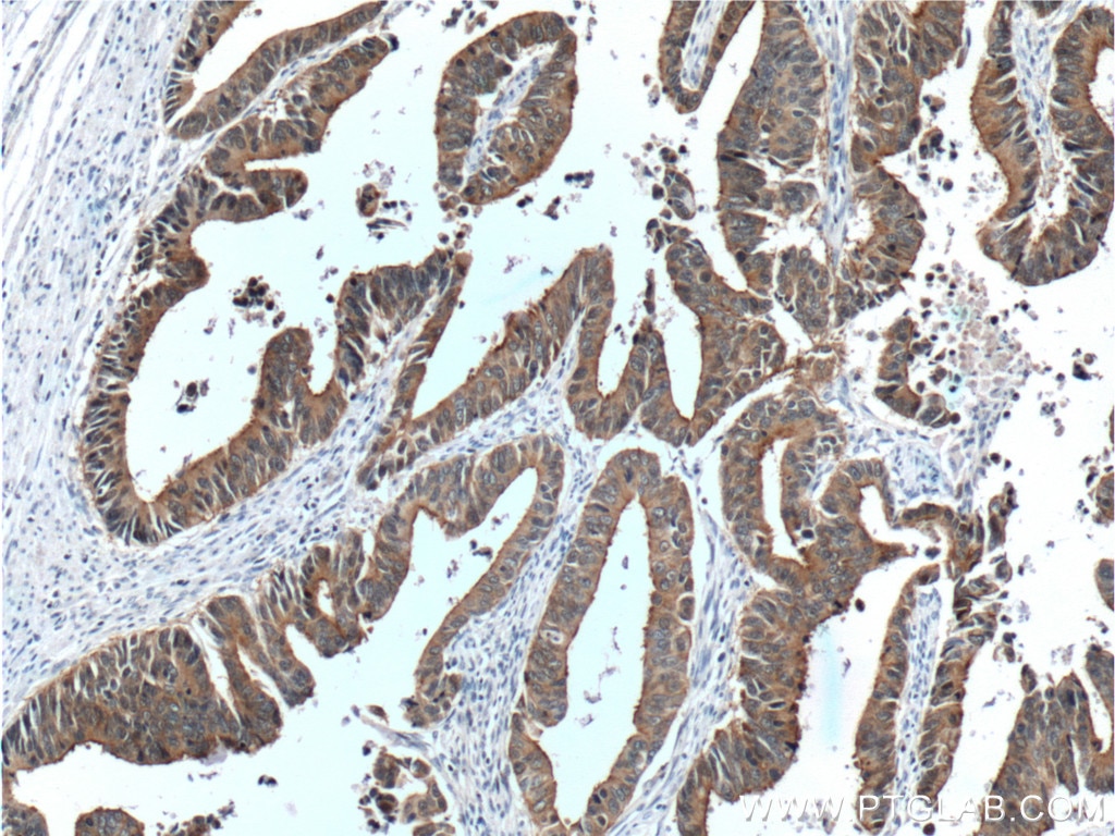 Immunohistochemistry (IHC) staining of human colon cancer tissue using Villin Monoclonal antibody (66096-1-Ig)