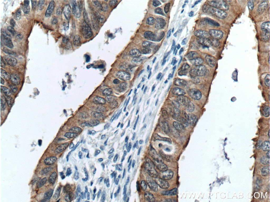 IHC staining of human colon cancer using 66096-1-Ig