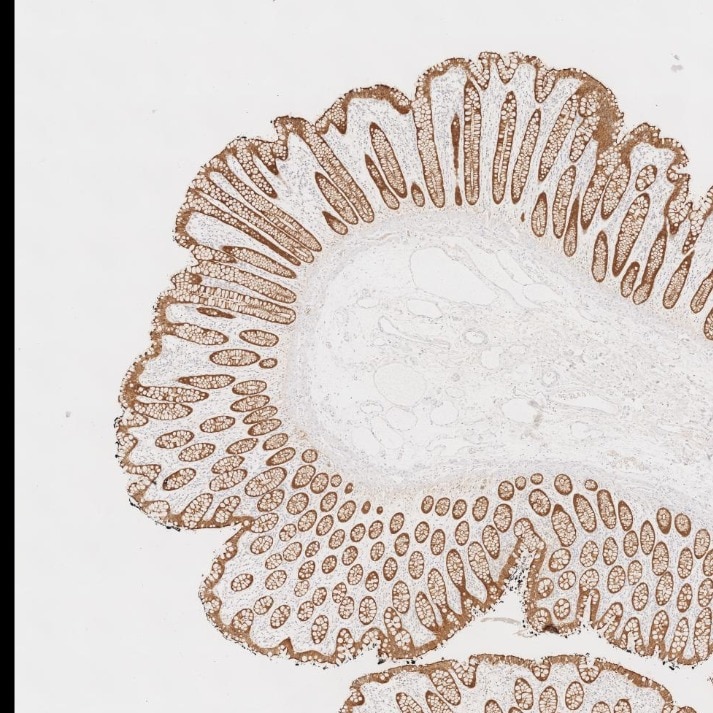 IHC staining of human large intestine using 66096-1-Ig Immunohistochemistry (IHC) staining of human large intestine tissue using Villin Monoclonal antibody (66096-1-Ig)