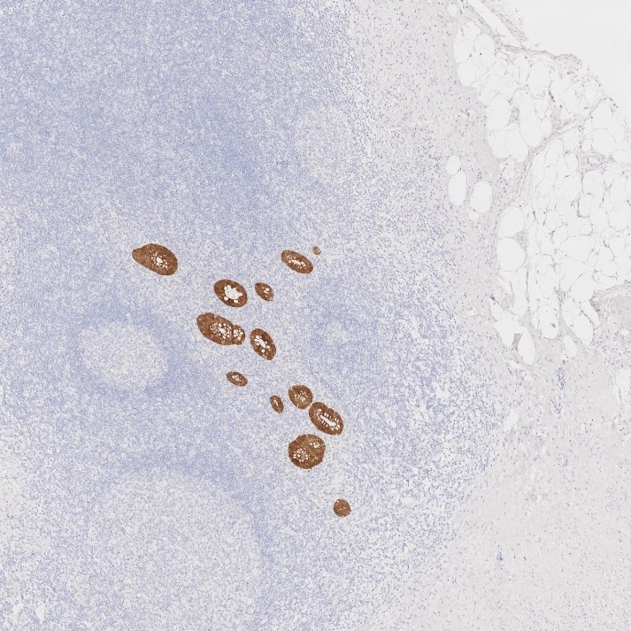 IHC staining of human appendicitis using 66096-1-Ig Immunohistochemistry (IHC) staining of human appendicitis tissue using Villin Monoclonal antibody (66096-1-Ig)