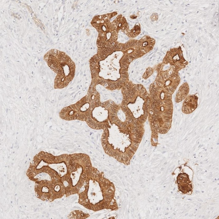 IHC staining of human pancreas cancer using 66096-1-Ig Immunohistochemistry (IHC) staining of human pancreas cancer tissue using Villin Monoclonal antibody (66096-1-Ig)