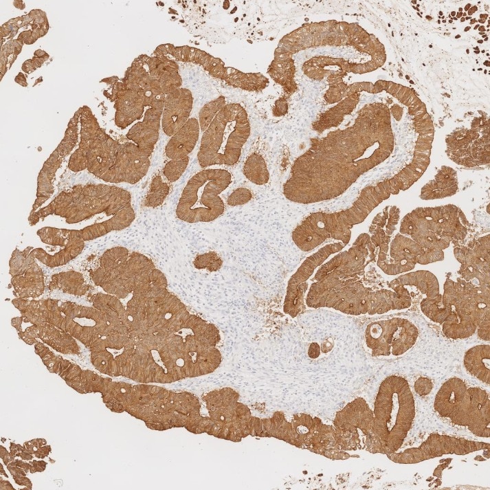 IHC staining of human colorectal cancer using 66096-1-Ig Immunohistochemistry (IHC) staining of human colorectal cancer tissue using Villin Monoclonal antibody (66096-1-Ig)