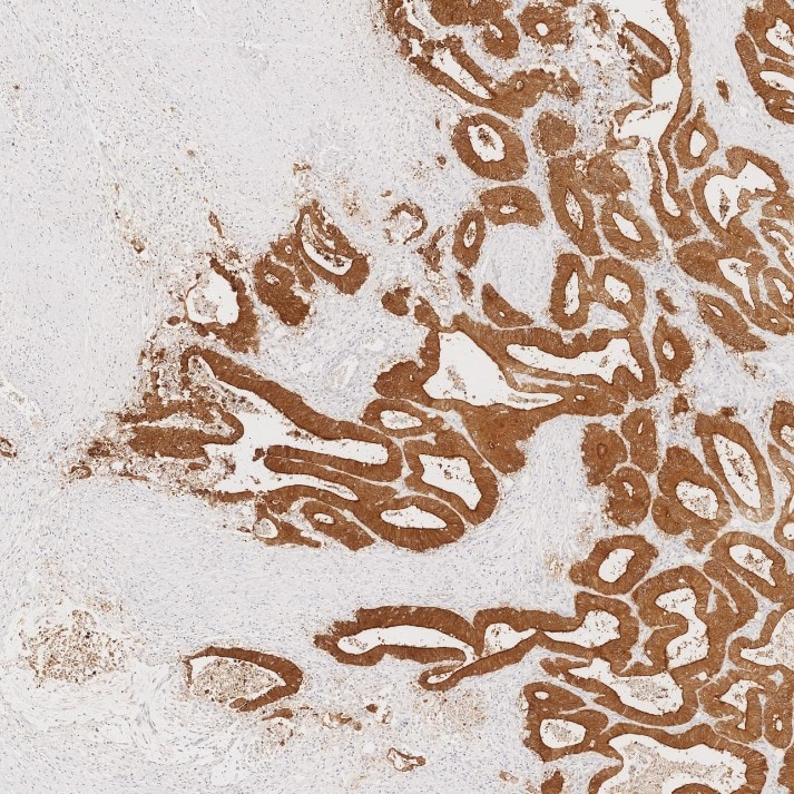 IHC staining of human colorectal cancer using 66096-1-Ig Immunohistochemistry (IHC) staining of human colorectal cancer tissue using Villin Monoclonal antibody (66096-1-Ig)
