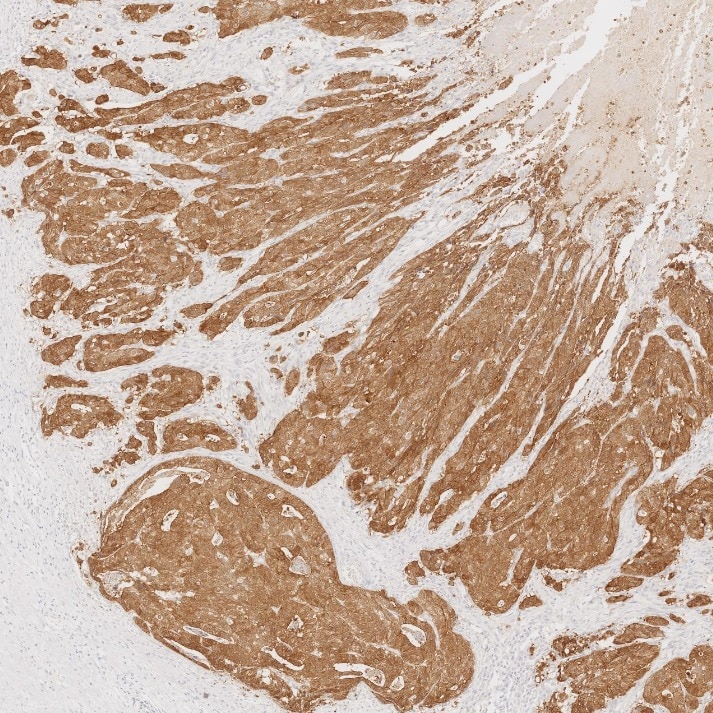 IHC staining of human stomach cancer using 66096-1-Ig Immunohistochemistry (IHC) staining of human stomach cancer tissue using Villin Monoclonal antibody (66096-1-Ig)