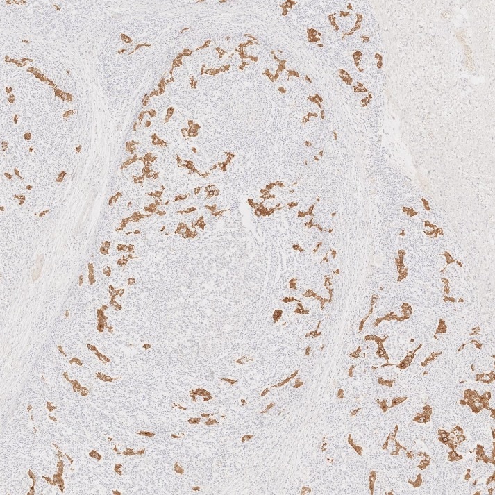 IHC staining of human stomach cancer using 66096-1-Ig Immunohistochemistry (IHC) staining of human stomach cancer tissue using Villin Monoclonal antibody (66096-1-Ig)