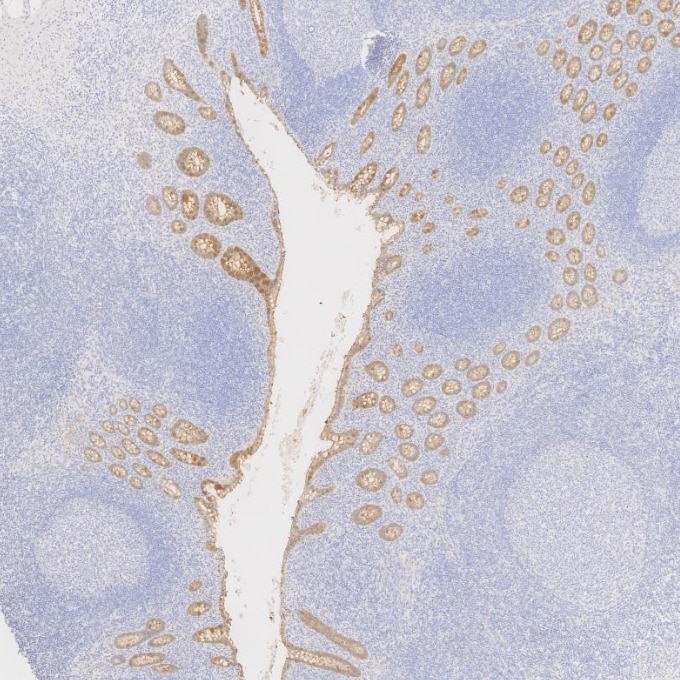 IHC staining of human appendicitis using 66096-1-Ig Immunohistochemistry (IHC) staining of human appendicitis tissue using Villin Monoclonal antibody (66096-1-Ig)