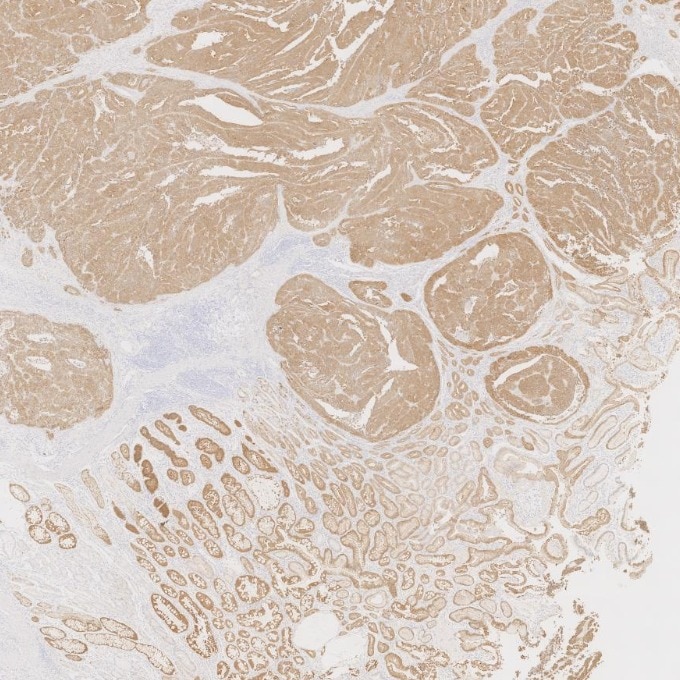 IHC staining of human stomach cancer using 66096-1-Ig Immunohistochemistry (IHC) staining of human stomach cancer tissue using Villin Monoclonal antibody (66096-1-Ig)