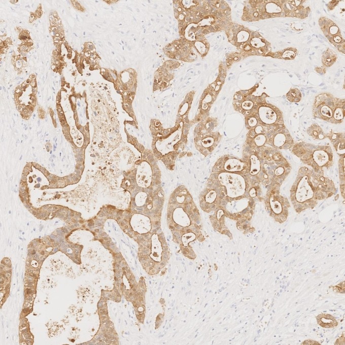IHC staining of human pancreas cancer using 66096-1-Ig Immunohistochemistry (IHC) staining of human pancreas cancer tissue using Villin Monoclonal antibody (66096-1-Ig)