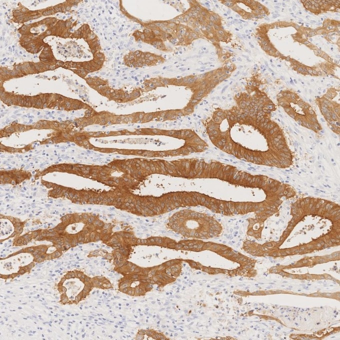 IHC staining of human colorectal cancer using 66096-1-Ig Immunohistochemistry (IHC) staining of human colorectal cancer tissue using Villin Monoclonal antibody (66096-1-Ig)