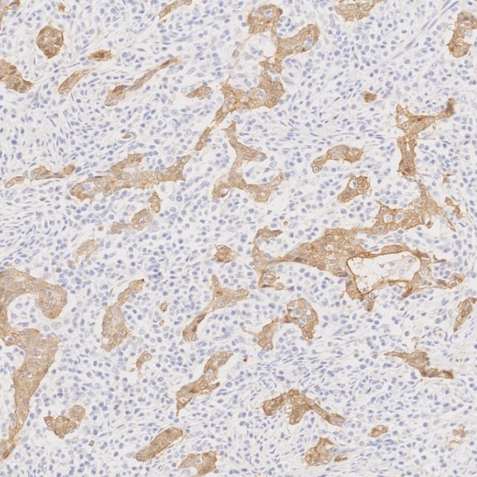 IHC staining of human stomach cancer using 66096-1-Ig Immunohistochemistry (IHC) staining of human stomach cancer tissue using Villin Monoclonal antibody (66096-1-Ig)