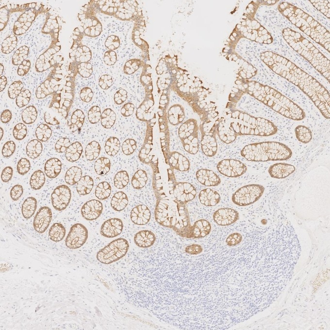 IHC staining of human large intestine using 66096-1-Ig Immunohistochemistry (IHC) staining of human large intestine tissue using Villin Monoclonal antibody (66096-1-Ig)