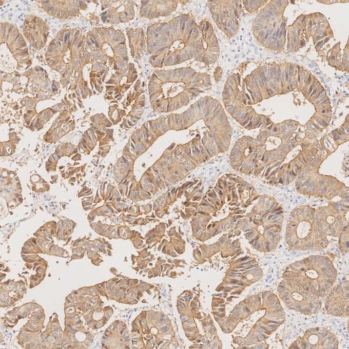 IHC staining of human colorectal cancer using 66096-1-Ig Immunohistochemistry (IHC) staining of human colorectal cancer tissue using Villin Monoclonal antibody (66096-1-Ig)