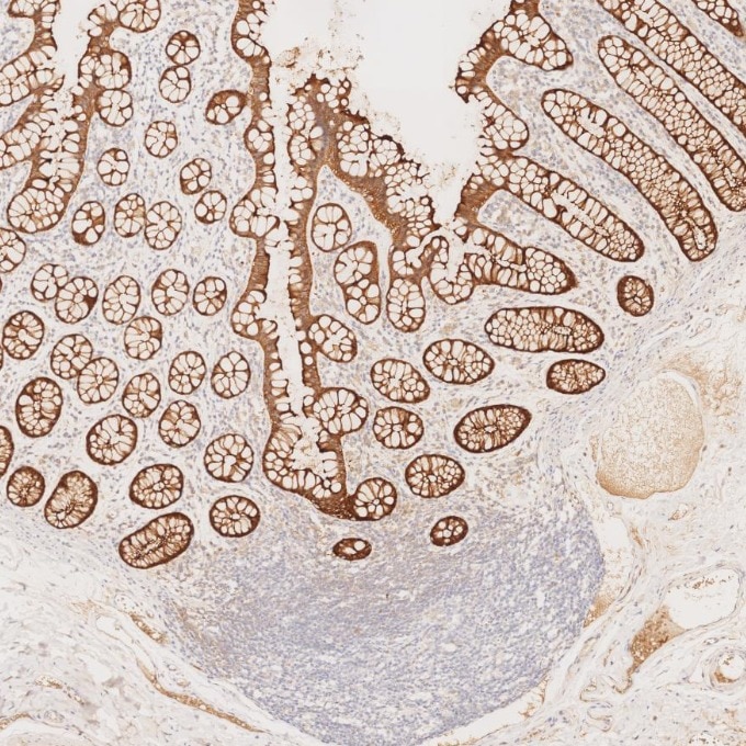 IHC staining of human large intestine using 66096-1-Ig Immunohistochemistry (IHC) staining of human large intestine tissue using Villin Monoclonal antibody (66096-1-Ig)