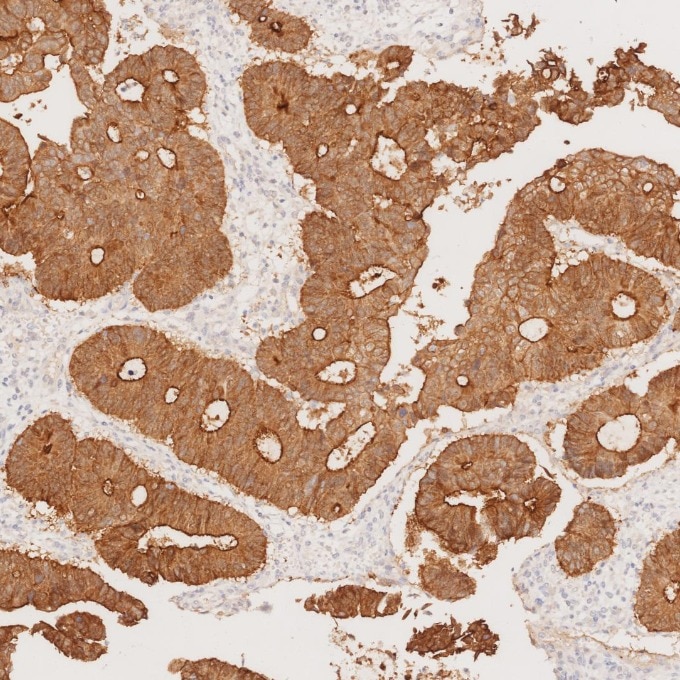 IHC staining of human colorectal cancer using 66096-1-Ig Immunohistochemistry (IHC) staining of human colorectal cancer tissue using Villin Monoclonal antibody (66096-1-Ig)