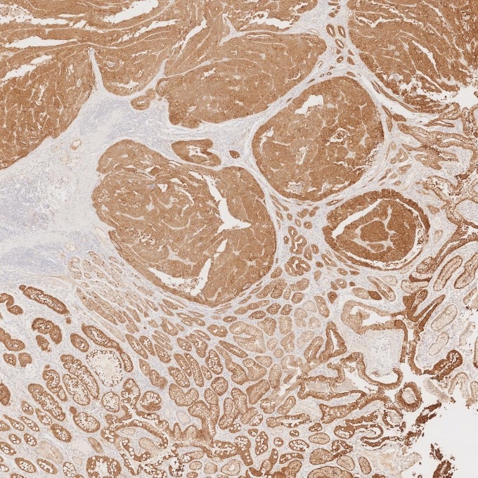 IHC staining of human stomach cancer using 66096-1-Ig Immunohistochemistry (IHC) staining of human stomach cancer tissue using Villin Monoclonal antibody (66096-1-Ig)