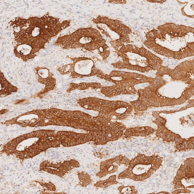 IHC staining of human colorectal cancer using 66096-1-Ig Immunohistochemistry (IHC) staining of human colorectal cancer tissue using Villin Monoclonal antibody (66096-1-Ig)
