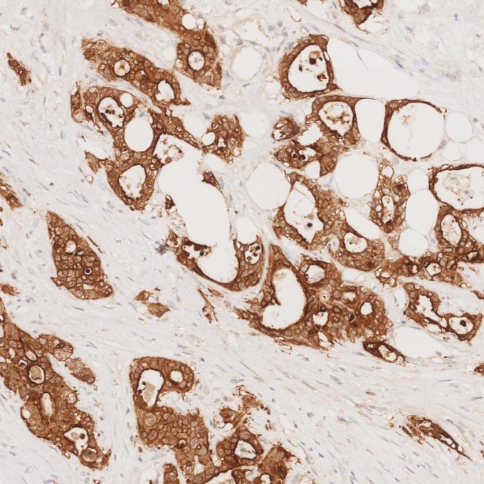 IHC staining of human pancreas cancer using 66096-1-Ig Immunohistochemistry (IHC) staining of human pancreas cancer tissue using Villin Monoclonal antibody (66096-1-Ig)