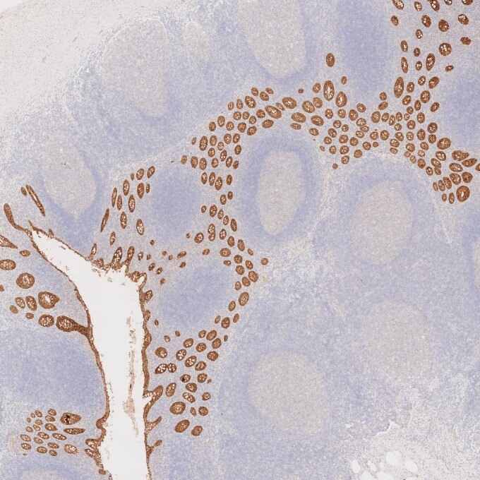 IHC staining of human appendicitis using 66096-1-Ig Immunohistochemistry (IHC) staining of human appendicitis tissue using Villin Monoclonal antibody (66096-1-Ig)