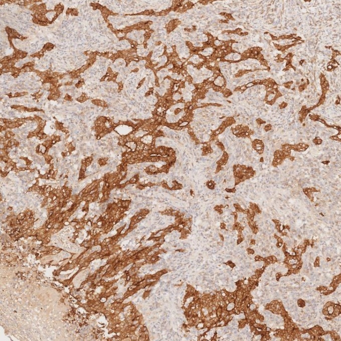 IHC staining of human stomach cancer using 66096-1-Ig Immunohistochemistry (IHC) staining of human stomach cancer tissue using Villin Monoclonal antibody (66096-1-Ig)