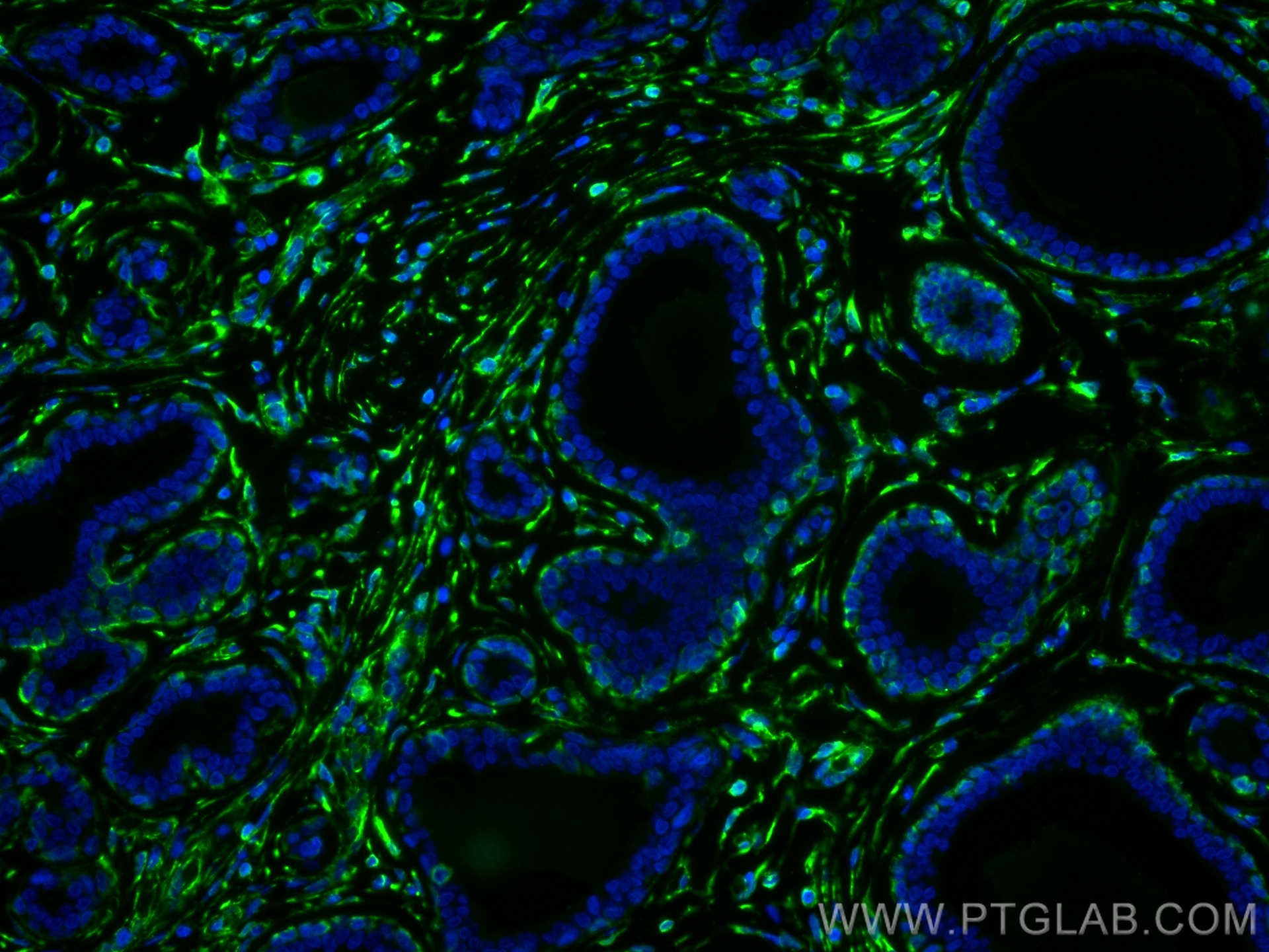 Immunofluorescence (IF) / fluorescent staining of human breast cancer tissue using Vimentin Polyclonal antibody (10366-1-AP)