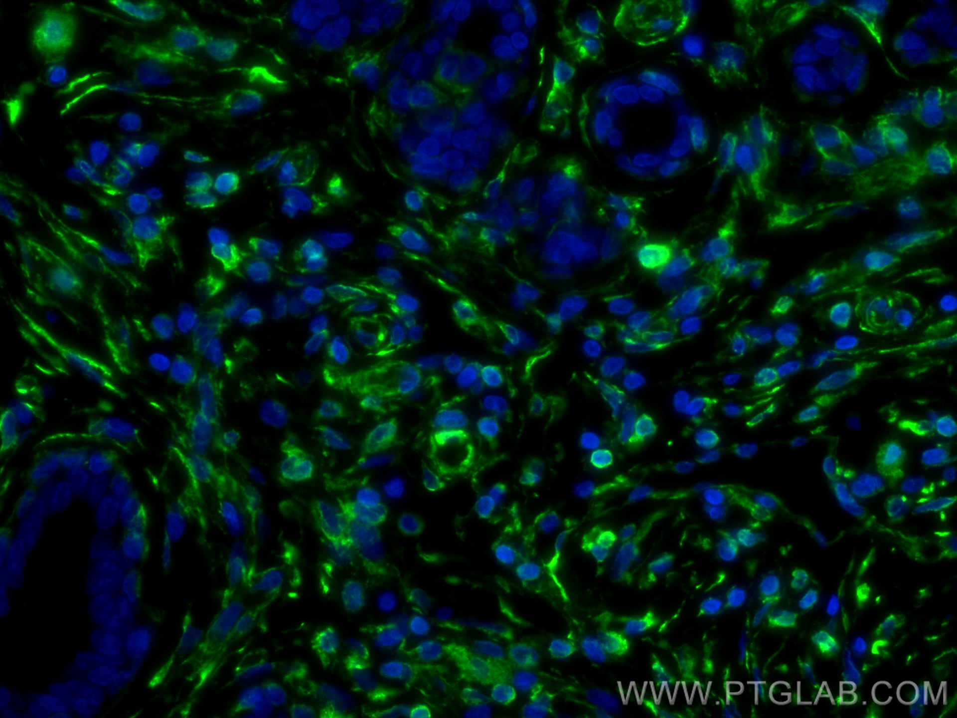 Immunofluorescence (IF) / fluorescent staining of human breast cancer tissue using Vimentin Polyclonal antibody (10366-1-AP)