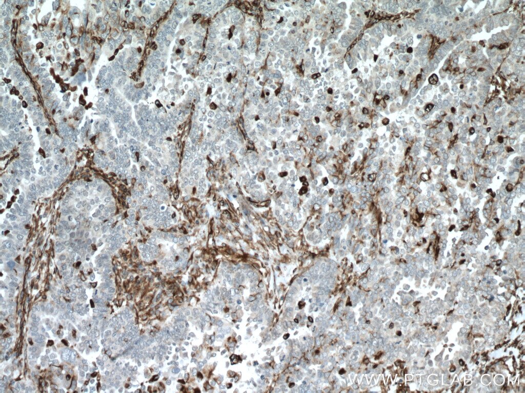 Immunohistochemistry (IHC) staining of human ovary tumor tissue using Vimentin Polyclonal antibody (10366-1-AP)