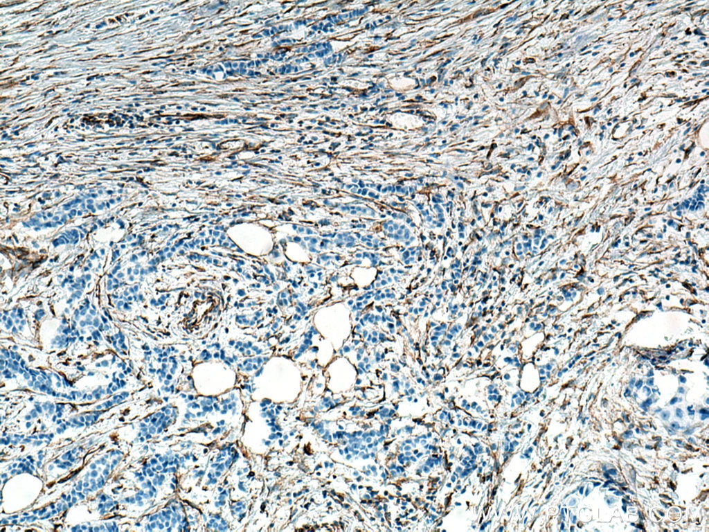 Immunohistochemistry (IHC) staining of human breast cancer tissue using Vimentin Polyclonal antibody (10366-1-AP)
