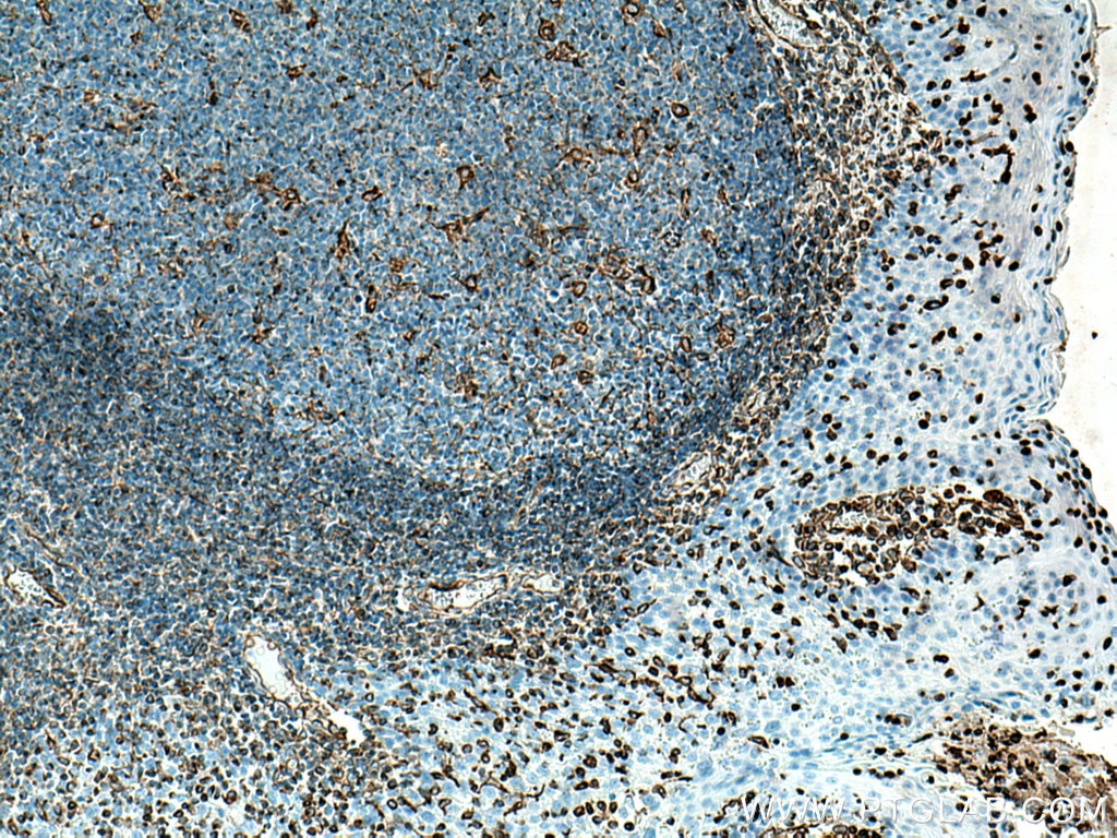 Immunohistochemistry (IHC) staining of human tonsillitis tissue using Vimentin Polyclonal antibody (10366-1-AP)