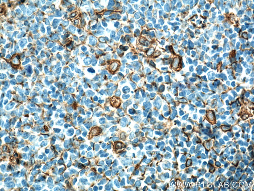 Immunohistochemistry (IHC) staining of human tonsillitis tissue using Vimentin Polyclonal antibody (10366-1-AP)
