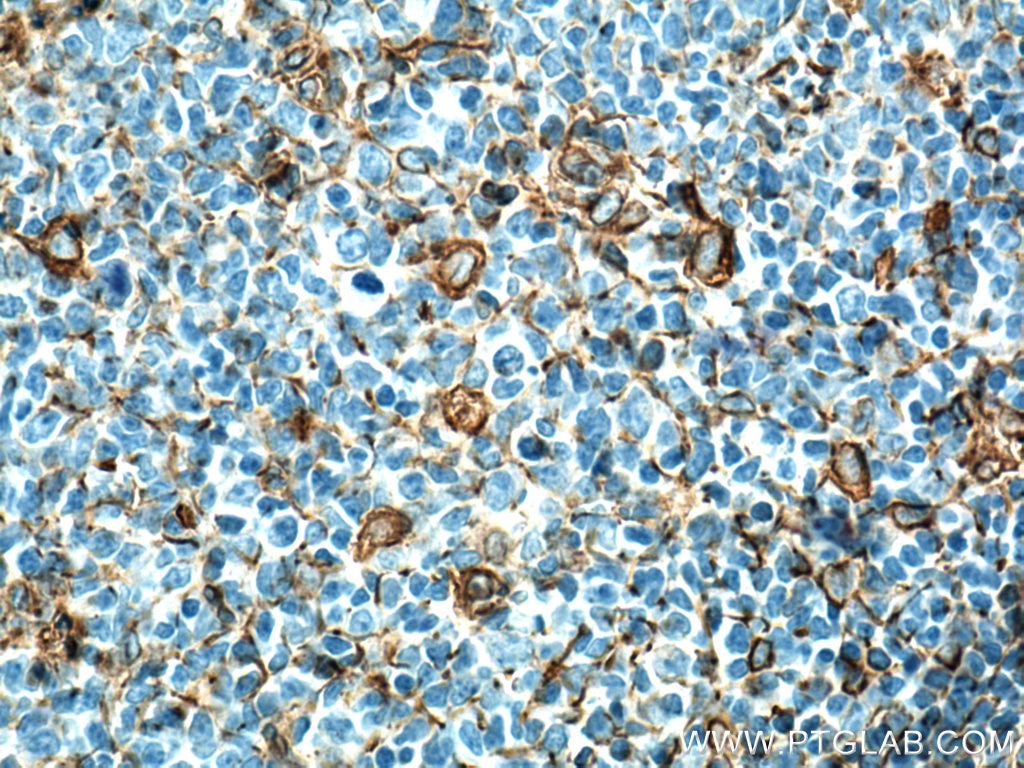 IHC staining of human tonsillitis using 10366-1-AP