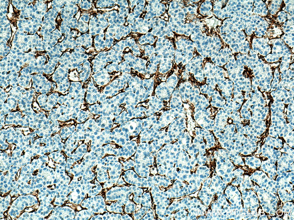 Immunohistochemistry (IHC) staining of human liver cancer tissue using Vimentin Polyclonal antibody (10366-1-AP)