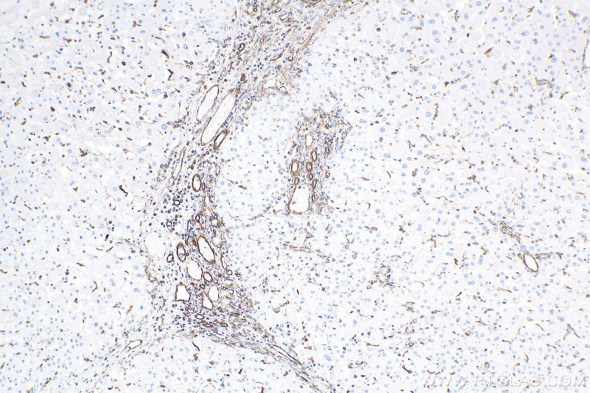 Immunohistochemistry (IHC) staining of human hepatocirrhosis tissue using Vimentin Polyclonal antibody (10366-1-AP)