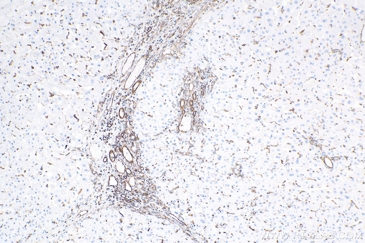 IHC staining of human hepatocirrhosis using 10366-1-AP