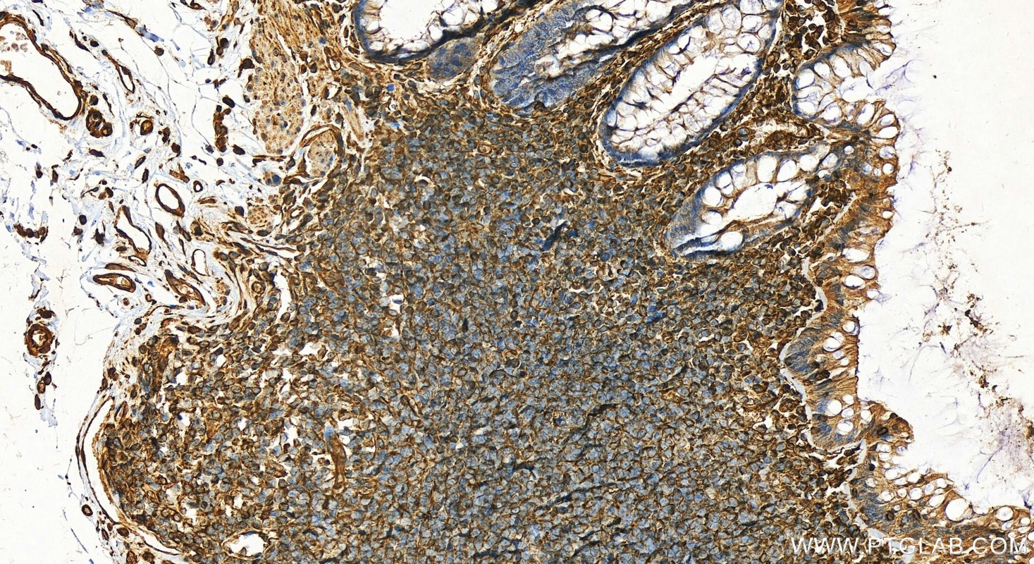 Immunohistochemistry (IHC) staining of human colon tissue using Vimentin Polyclonal antibody (22031-1-AP)