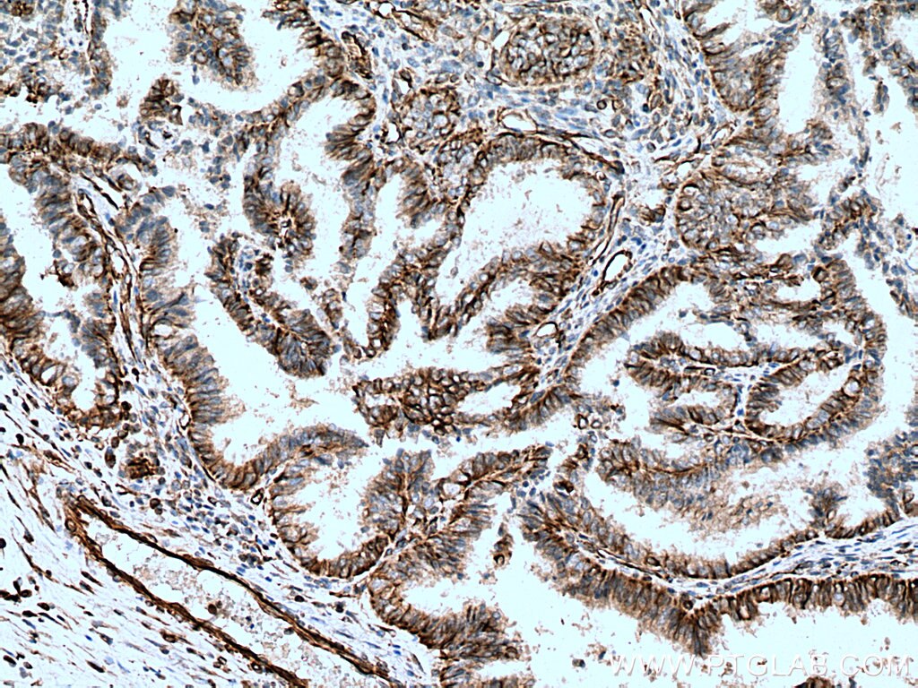 IHC staining of human ovary tumor using 22031-1-AP