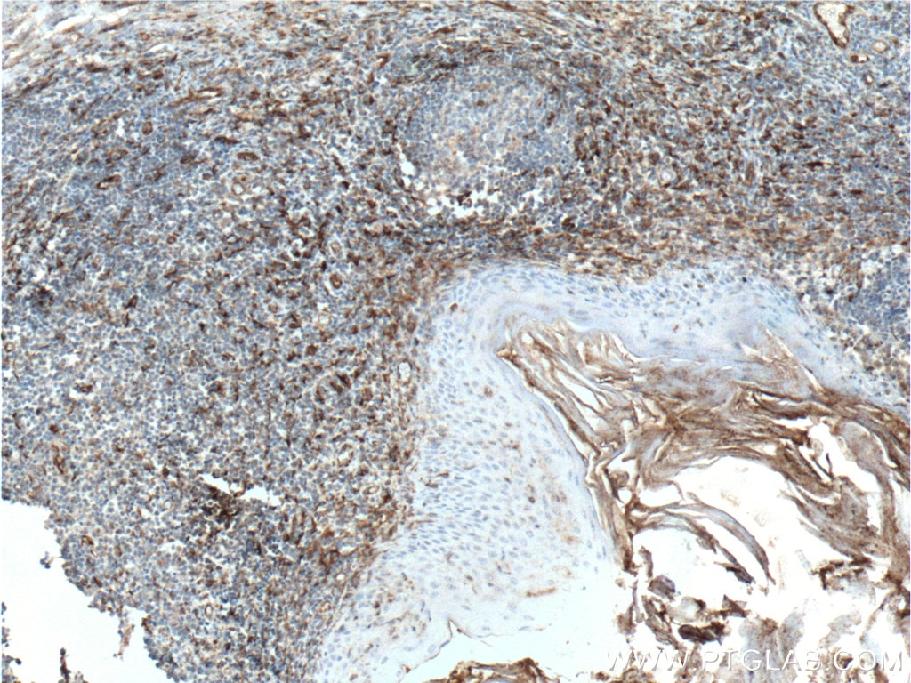 IHC staining of human tonsillitis using 22031-1-AP