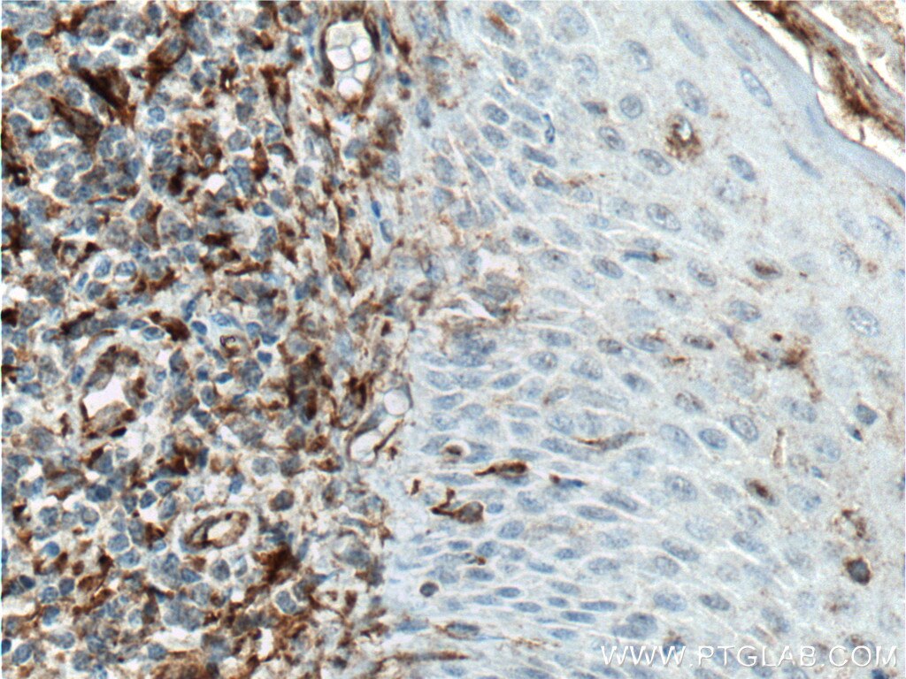 IHC staining of human tonsillitis using 22031-1-AP