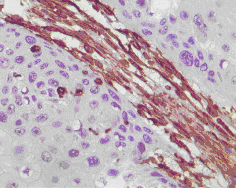 Immunohistochemistry (IHC) staining of human lung cancer tissue using VIM Monoclonal antibody (65039-1-Ig)