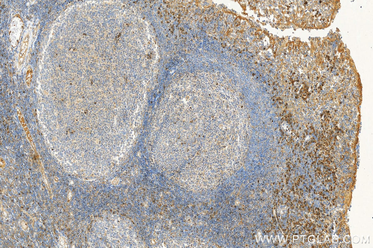 Immunohistochemistry (IHC) staining of human tonsillitis tissue using VISTA Polyclonal antibody (31619-1-AP)